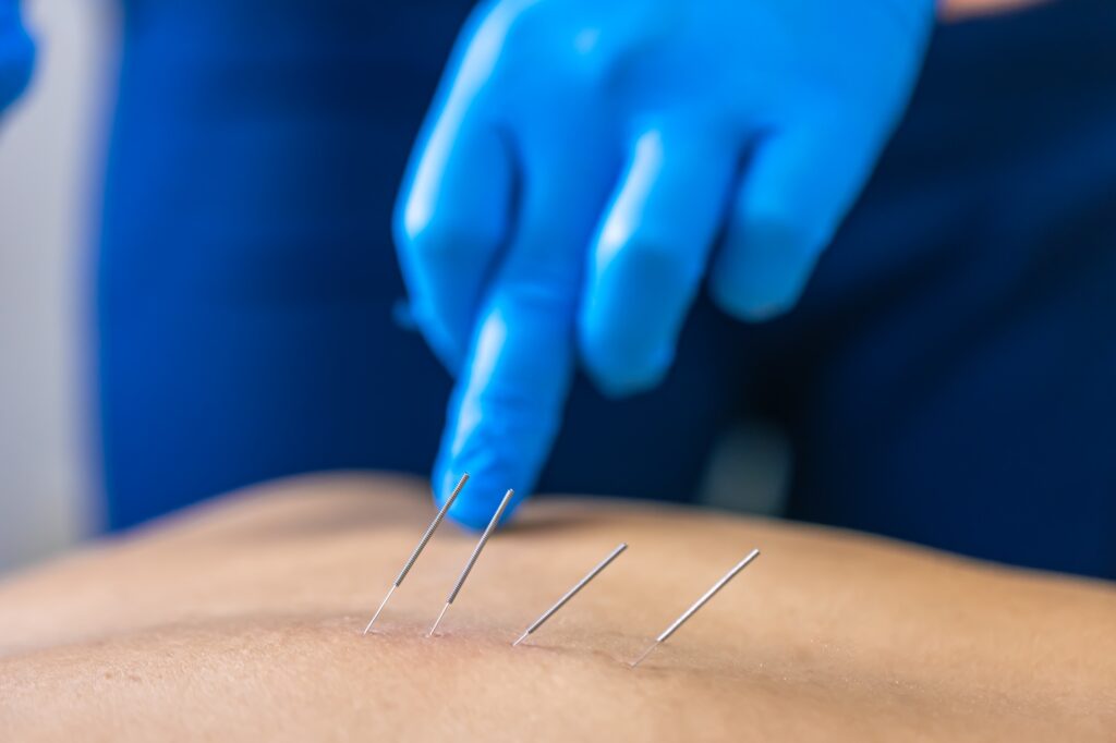 Close up of a needle and hands of physiotherapist doing a dry needling.