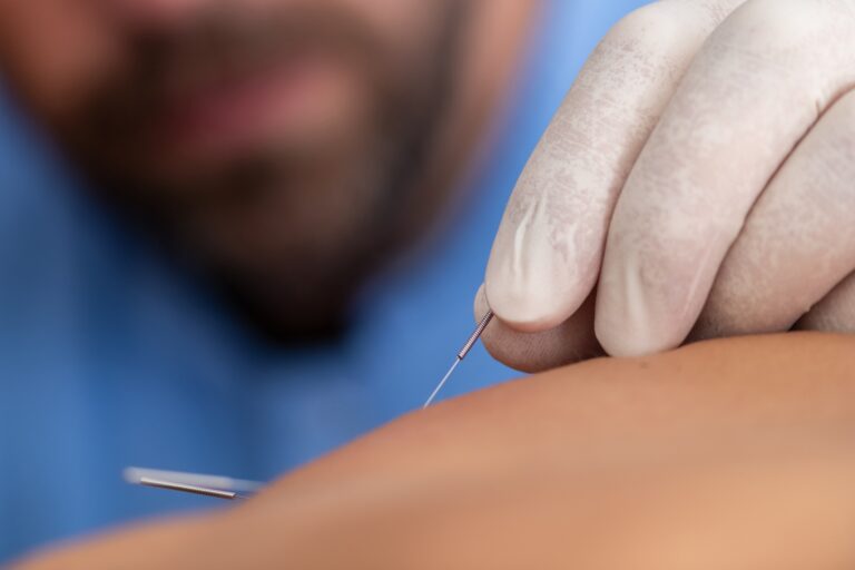 Physical therapist performing dry needling on a patient's back to target muscle knots