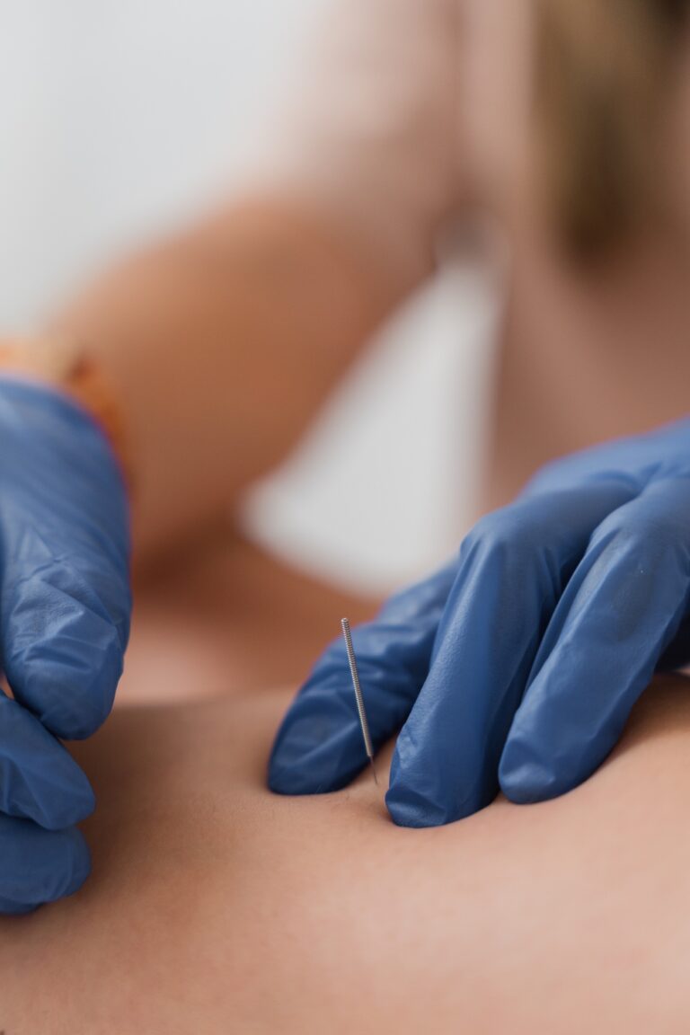 Physiotherapist applying dry needling therapy to patient's back